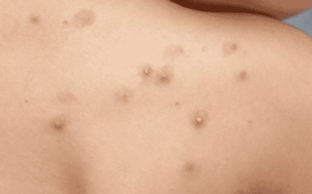 Viruela símica en Yucatán: un llamado a la prevención y la vigilancia