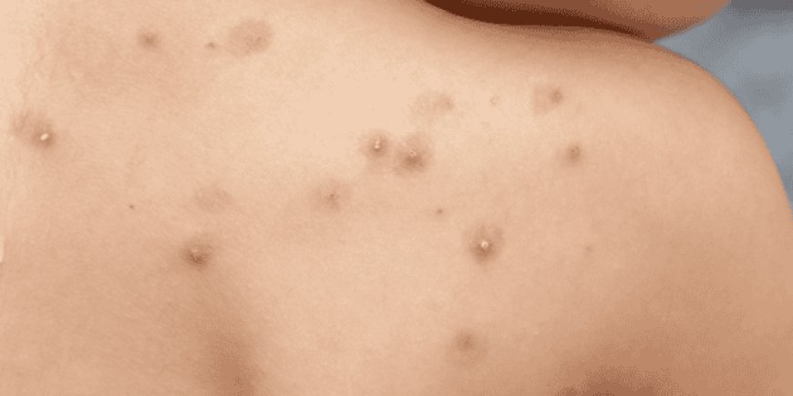 Viruela símica en Yucatán: un llamado a la prevención y la vigilancia