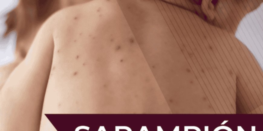 El Resurgimiento del Sarampión en México: Una Alerta Urgente